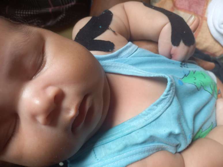Alderico had a dislocated shoulder at birth and has been undergoing physiotherapy for two months.