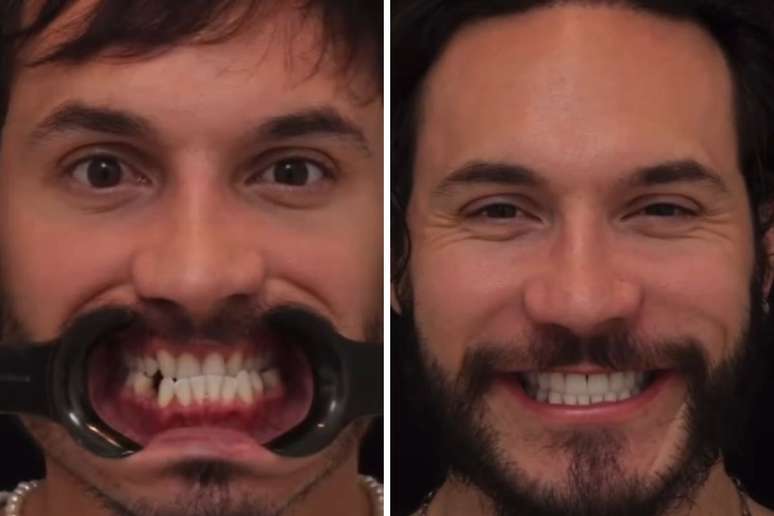 Eliezer mostra antes e depois de procedimentos estéticos no dente