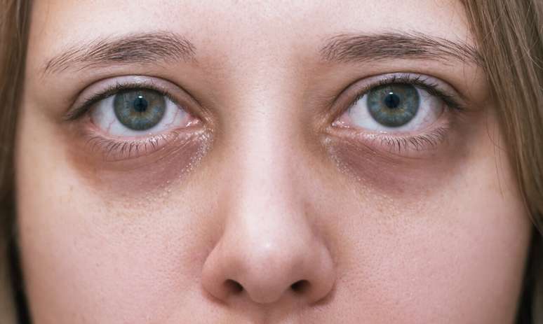 Dermatologistas ensinam como tratar os diferentes tipos de olheiras / Foto: Shutterstock