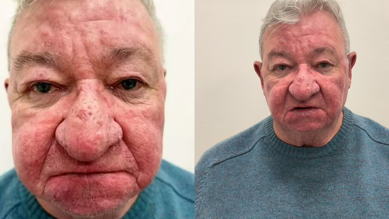 Escocês com nariz gigante se submete a cirurgia para reparar condição rara