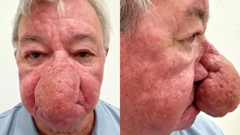 Escocês com nariz gigante se submete a cirurgia para reparar condição rara