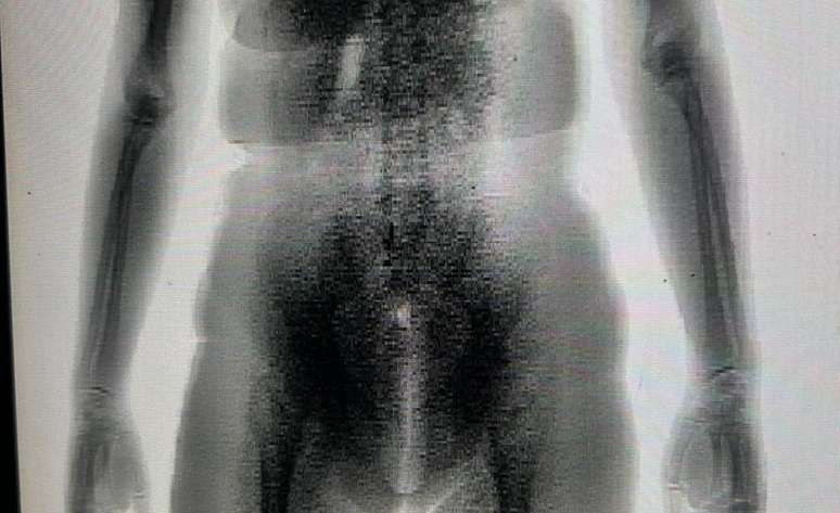 A imagem do BodyScan mostrou um volume estranho no corpo da mulher