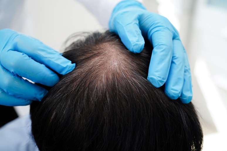 Baldness can affect self-esteem in men and women Baldness can affect self-esteem in men and women
