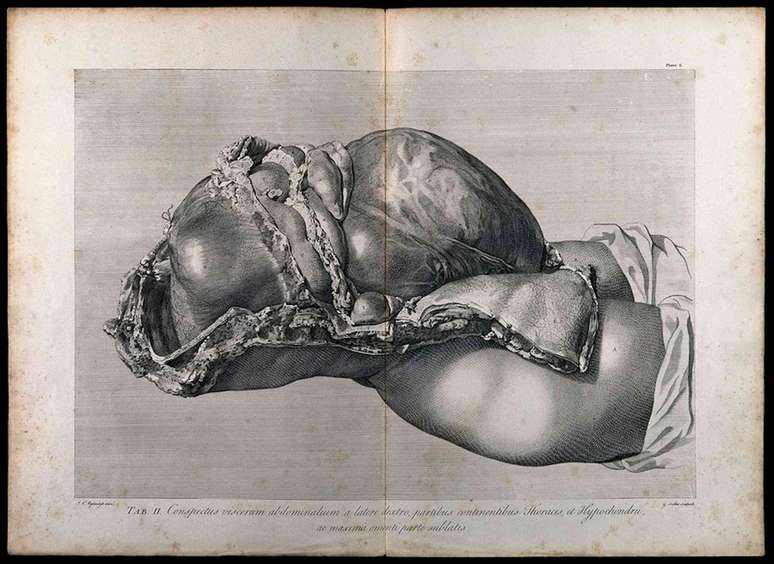 O útero grávido. Gravura em cobre de G. Scotin baseada em I.V. Rymsdyk, para W. Hunter The Gravid Uterus. 1774, reimpresso em 1851.