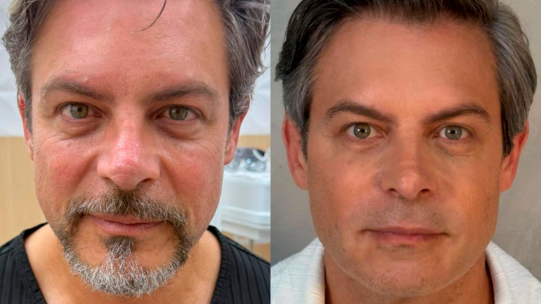 Luigi Baricelli antes e depois da harmoniza&ccedil;&atilde;o facial