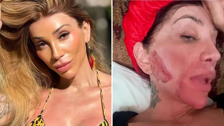 What happened to Maya Massafera’s face? The expert analyzes severe burns What happened to Maya Massafera’s face? The expert analyzes severe burns