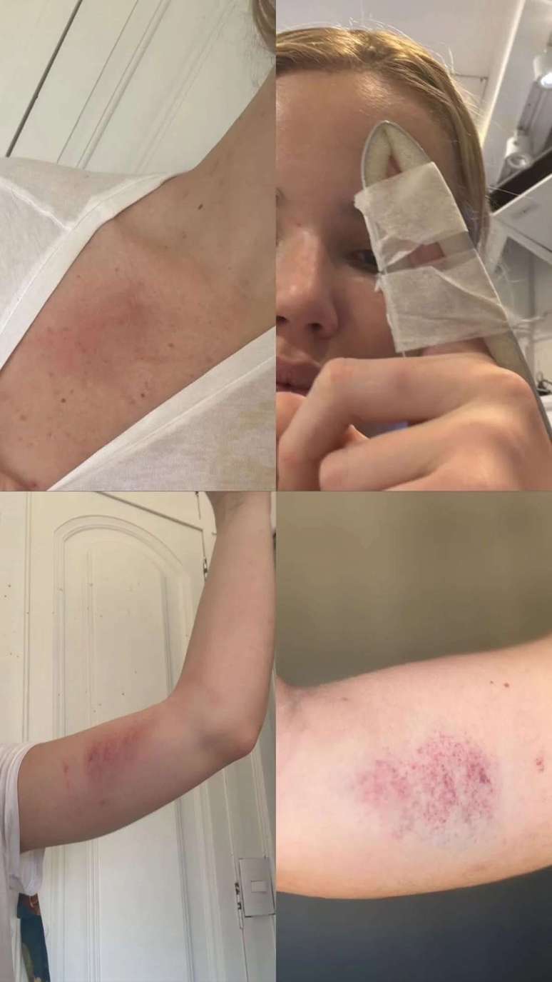 Friend publishes photos of Marcela Tomaszewski injured after being attacked by Dado Dolabella Friend publishes photos of Marcela Tomaszewski injured after being attacked by Dado Dolabella