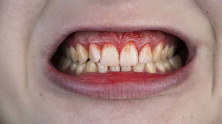 Gingivitis: what is it and how to treat it? Gingivitis: what is it and how to treat it?