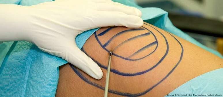 Liposuction: the most performed plastic surgery procedure in Brazil Liposuction: the most performed plastic surgery procedure in Brazil