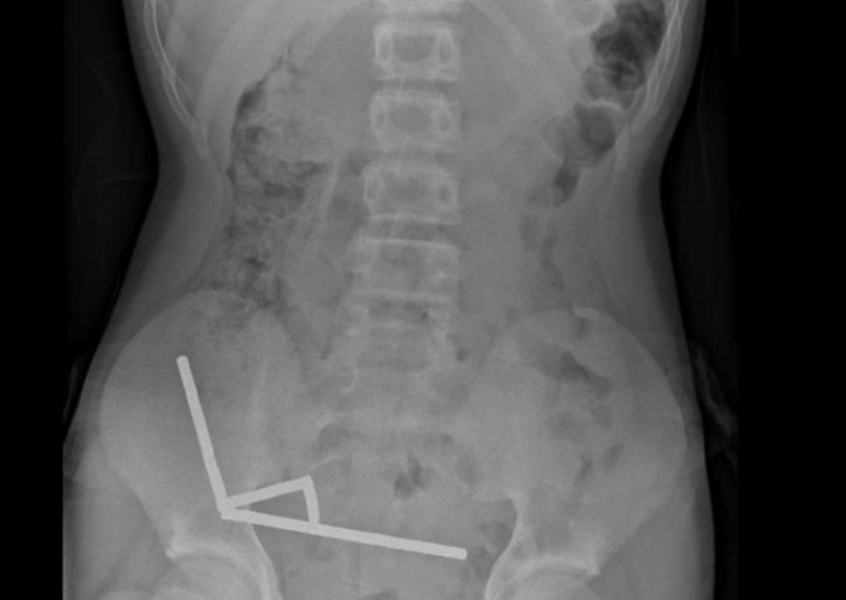 A teenager loses part of his intestine after swallowing more than 80 magnets A teenager loses part of his intestine after swallowing more than 80 magnets