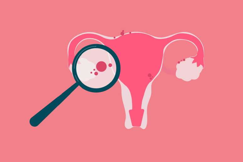 As consultas regulares ajudam na identifica&ccedil;&atilde;o precoce de problemas ginecol&oacute;gicos 