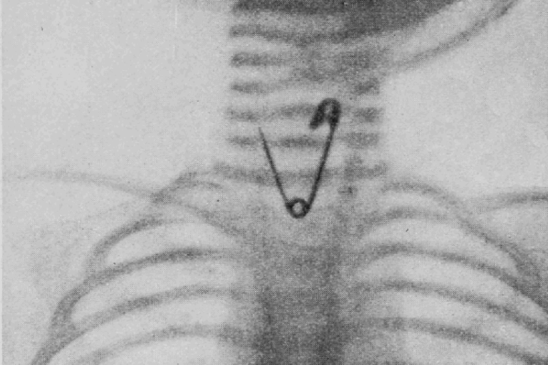 Brasileiros desenvolvem técnica precisa e acessível para localizar objetos metálicos no corpo, tornando cirurgias de remoção mais rápidas e eficazes.