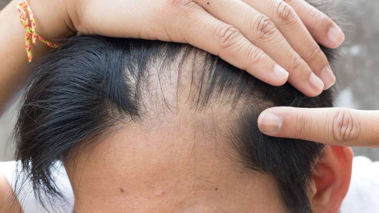 O minoxidil é um produto disponível em solução tópica ou espuma, cuja principal função é estimular os folículos capilares, prolongando a fase de crescimento dos fios -= depositphotos.com / wasansos1