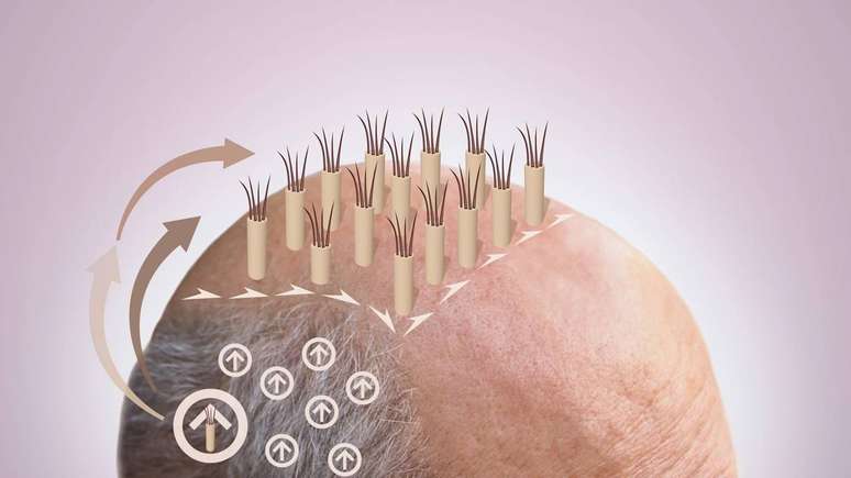 Ap&oacute;s o implante, o acompanhamento m&eacute;dico e a aten&ccedil;&atilde;o aos cuidados di&aacute;rios s&atilde;o fundamentais para o sucesso do enxerto e a conquista de um visual natural e saud&aacute;vel &ndash; depositphotos.com / Marina113