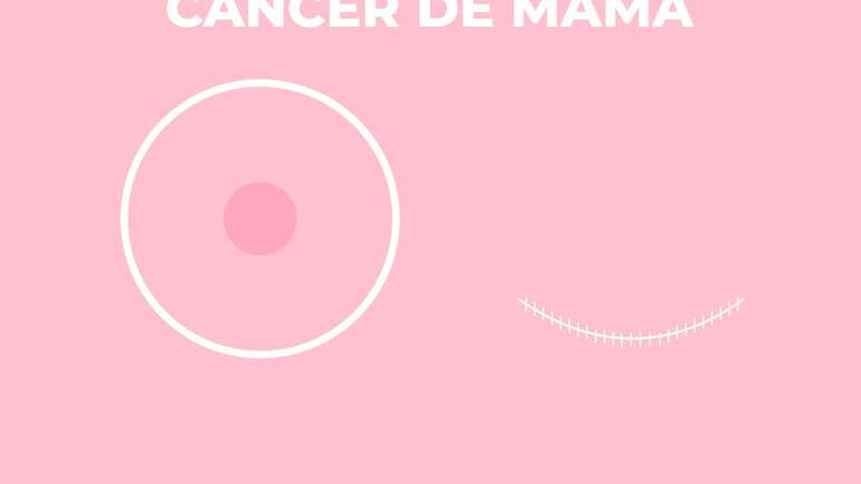 Mammography: essential test for the early diagnosis of breast cancer