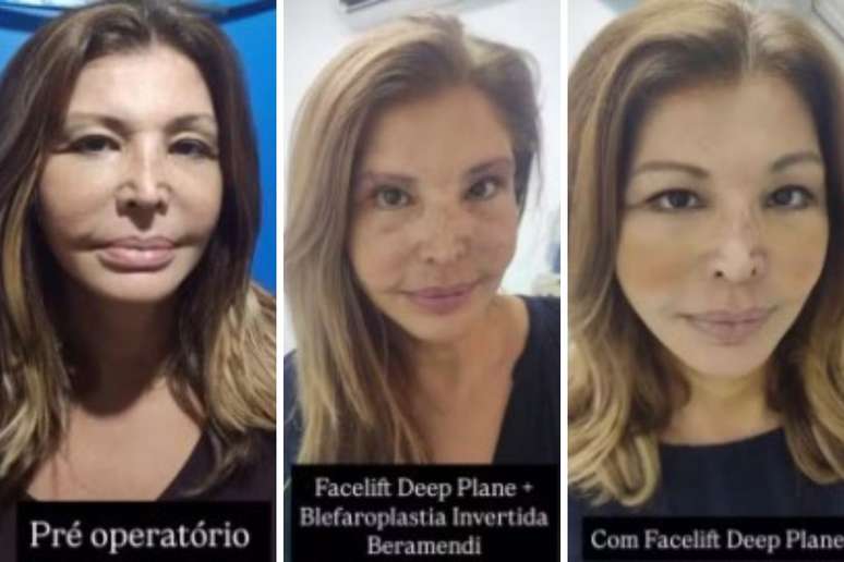 Roberta Close shows the before and after the interventions