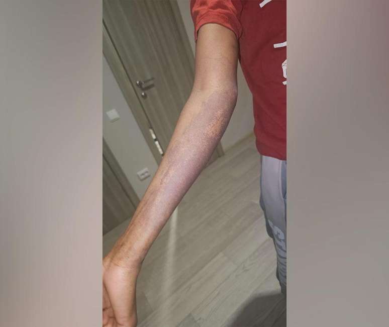 Queimaduras qu&iacute;micas no bra&ccedil;o de colega de Adau