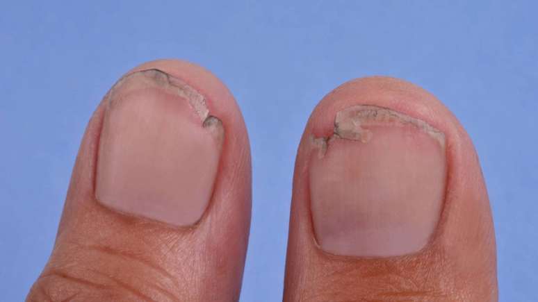 Se houver dor intensa, sangramento persistente ou sinais de infecção, é importante procurar um especialista para tratamento adequado – depositphotos.com / modesto3