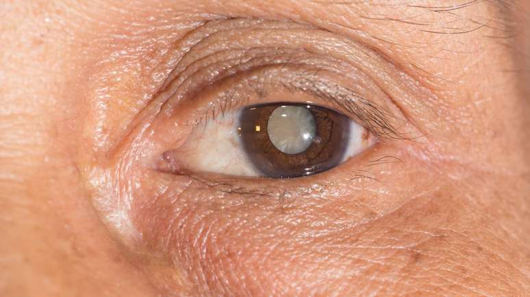 Catarata &ndash; depositphotos.com / arztsamui