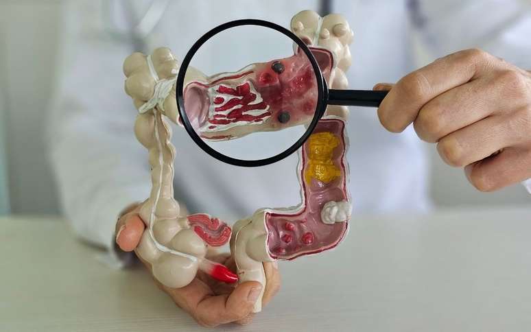 Estudos indicam o que pode aumentar o surgimento dessa doença. /