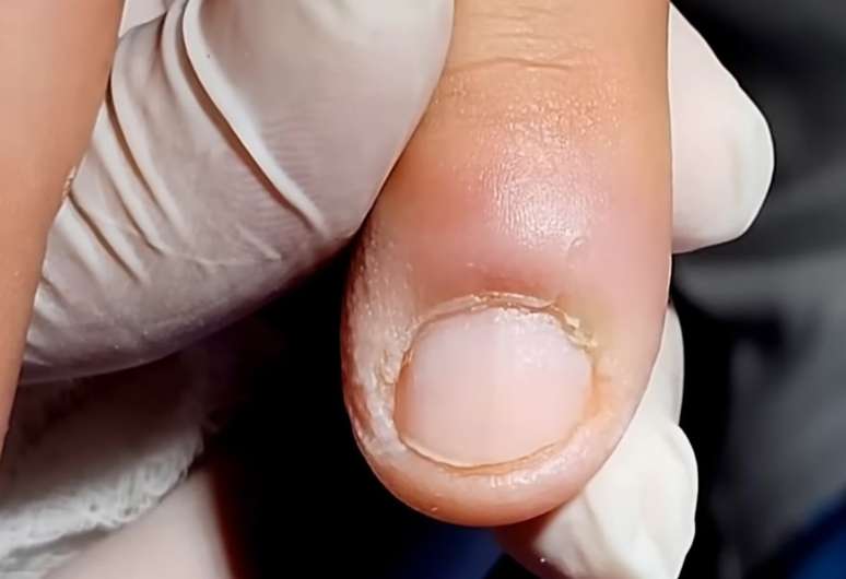 Tratamento e aten&ccedil;&atilde;o m&eacute;dica: compressas mornas e higiene local ajudam nos casos leves, mas infec&ccedil;&otilde;es com pus exigem avalia&ccedil;&atilde;o profissional &ndash; Reprodu&ccedil;&atilde;o de v&iacute;deo