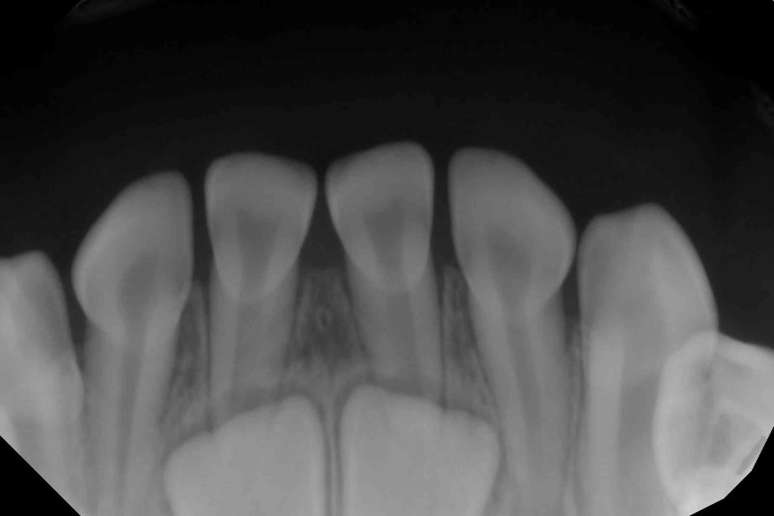 Imagem em preto e branco mostra uma fileira de dentes pequenos com raízes – abaixo deles, há dois dentes brancos maiores