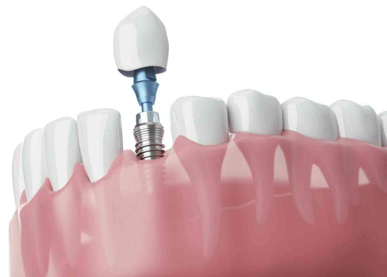 Imagem digital gerada de um dente artificial implantado com um parafuso na base, fixado à mandíbula