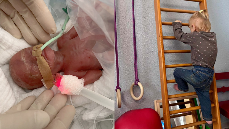 De acordo com a equipe médica do Hospital Universitário de Magdeburgo, na Alemanha, o bebê tinha apenas 25% de chance de sobreviver