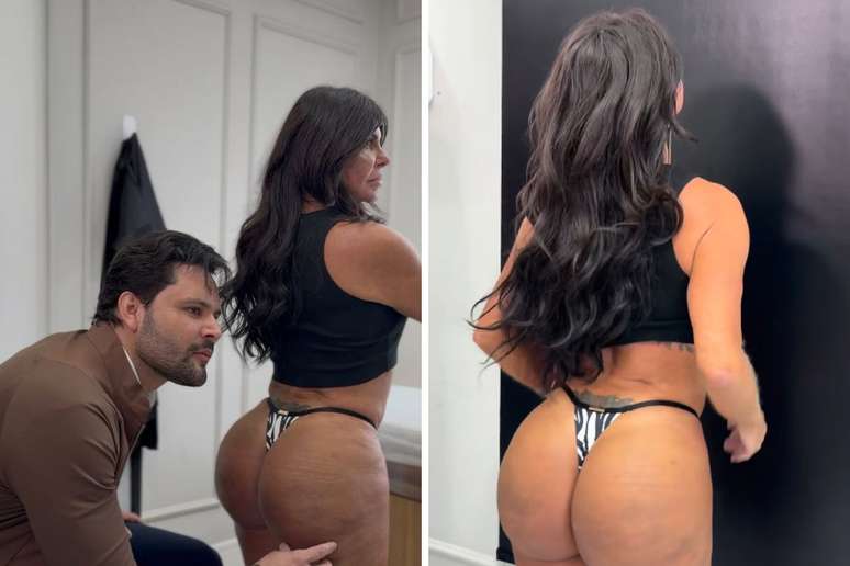 Gretchen mostra resultado de procedimento no bumbum