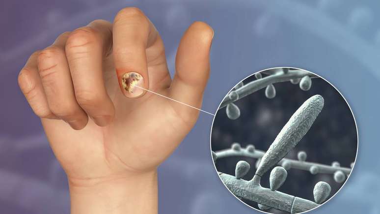 Alguns sintomas, como descolamento da unha do leito, odor forte, formação de detritos sob a unha ou dor persistente, requerem avaliação por dermatologista – depositphotos.com / katerynakon