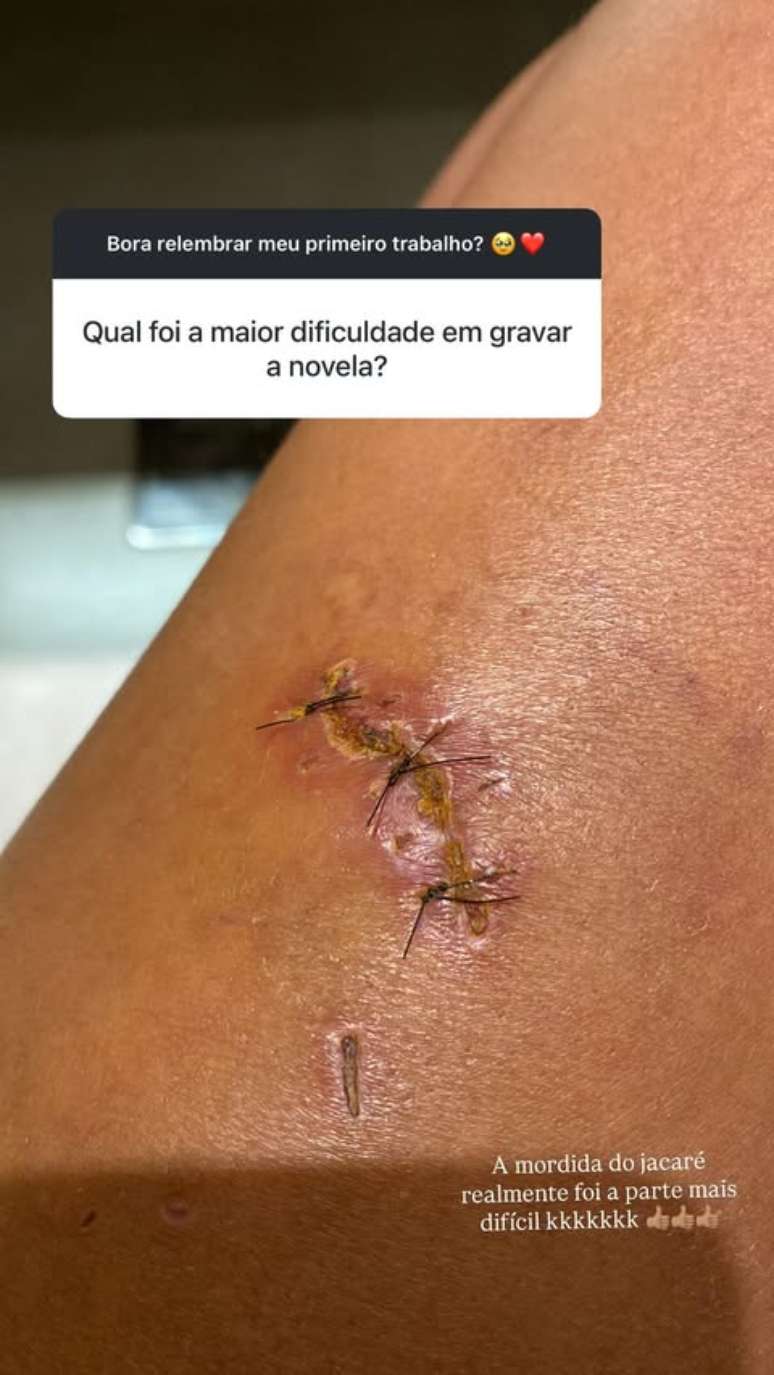 A atriz foi mordida por um jacar&eacute; durante as grava&ccedil;&otilde;es de sua primeira novela 