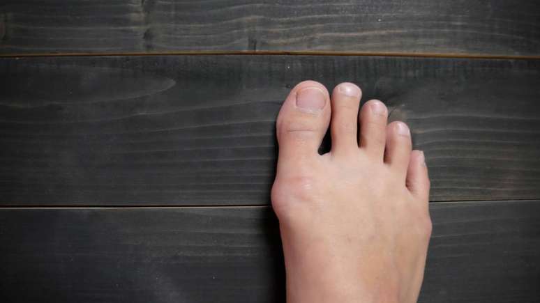 Quando os sintomas se tornam persistentes, tratamentos como fisioterapia ou cirurgia podem restaurar o alinhamento do p&eacute; e aliviar o impacto da deformidade &ndash; depositphotos.com / mukkudk