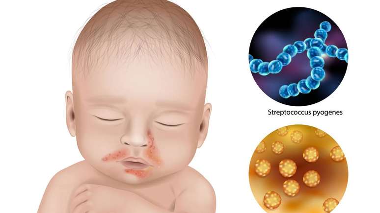 Preven&ccedil;&atilde;o e tratamento envolvem higiene constante, pomadas antibi&oacute;ticas ou medicamentos orais &ndash; depositphotos.com / Sakurra