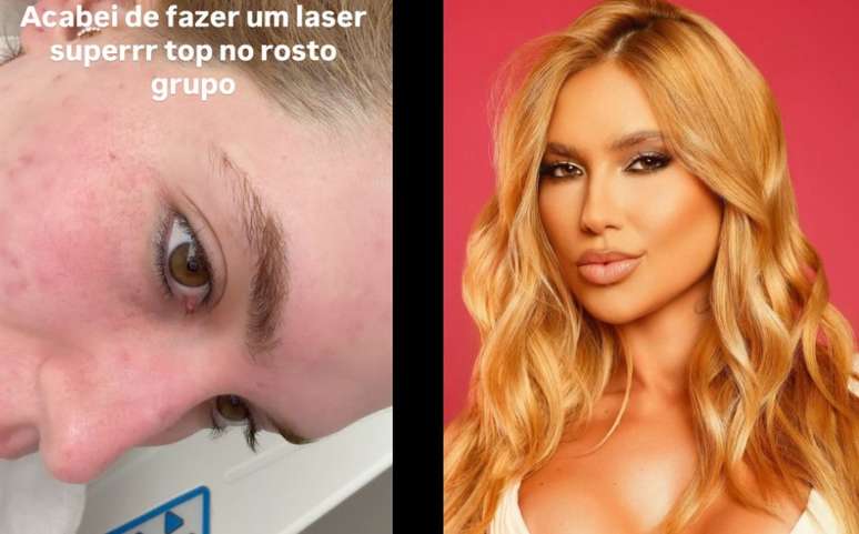 మొటిమల గుర్తులను తొలగించడానికి వర్జీనియా చికిత్స తీసుకుంటుంది