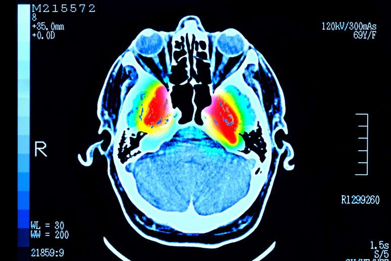 மனநல கோளாறுகள் மற்றும் டிமென்ஷியாவின் ஆபத்து ஆயுட்காலம் முழுவதும் ஏன் மாறுபடுகிறது என்பதைப் புரிந்துகொள்ள முடிவுகள் உதவக்கூடும் என்று ஆராய்ச்சியாளர்கள் கூறுகின்றனர்.