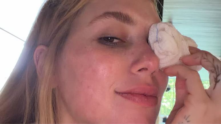 Virgnia aparece com lesão no olho após acidente com Maria Flor