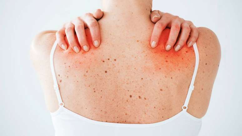 Quando uma pessoa sensibilizada ingere carne de animais como boi, porco ou cordeiro, seu sistema imunológico identifica o alfa-gal como um invasor e desencadeia uma resposta alérgica – depositphotos.com / AndrewLozovyi