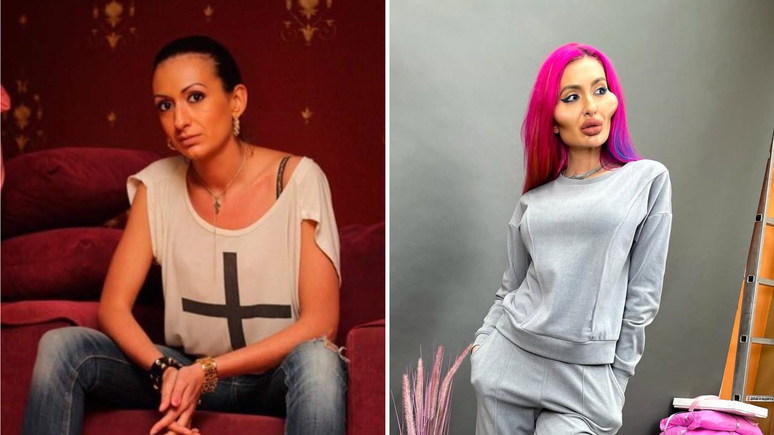 Mulher com as ‘maiores maçãs do rosto do mundo’ mostra antes e depois e choca web