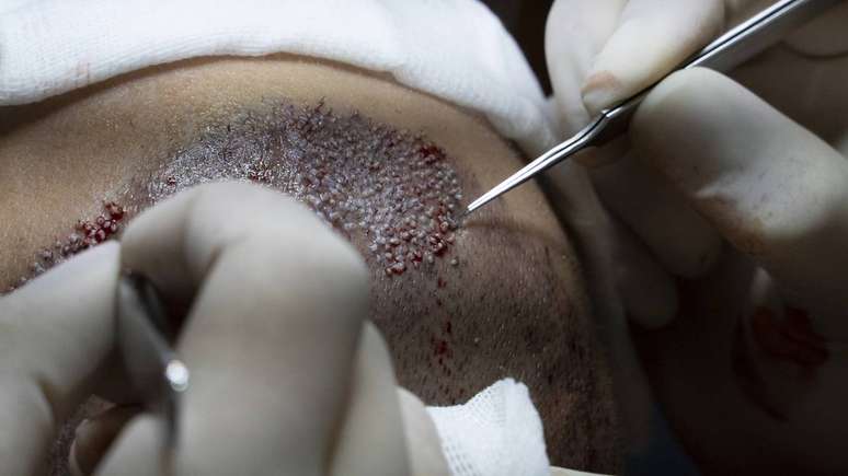 transplante capilar -depositphotos.com / onurtonba