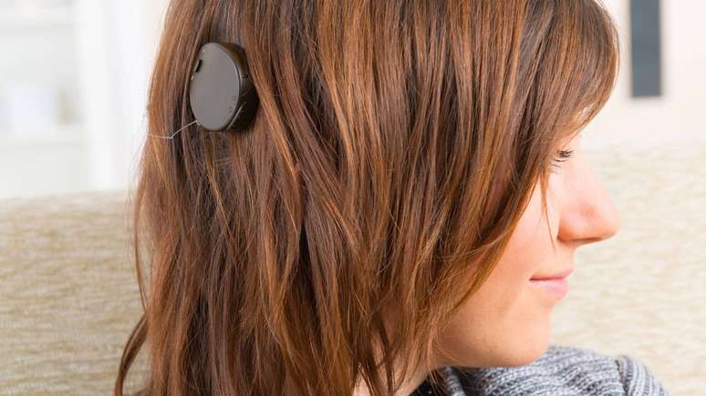 A indicação do dispositivo é para pessoas com surdez bilateral severa ou profunda, que obtiveram pouco ou nenhum benefício com o uso de aparelhos auditivos – depositphotos.com / Amaviael