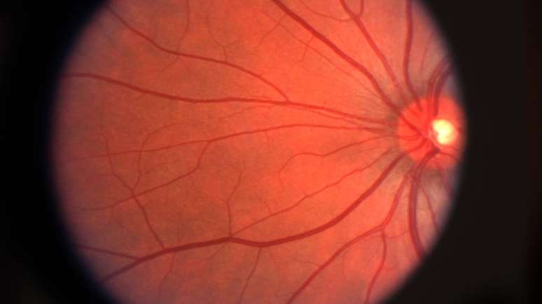 In many cases of macular degeneration, the cells stop working, which greatly affects the central vision of those affected.