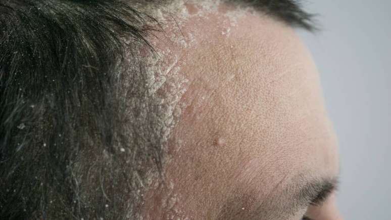 muitas pessoas procuram alternativas para tornar o dia a dia mais fácil, minimizando seus sintomas e aprendendo a lidar de forma adequada com a manifestação da seborreia – depositphotos.com / SergeVo