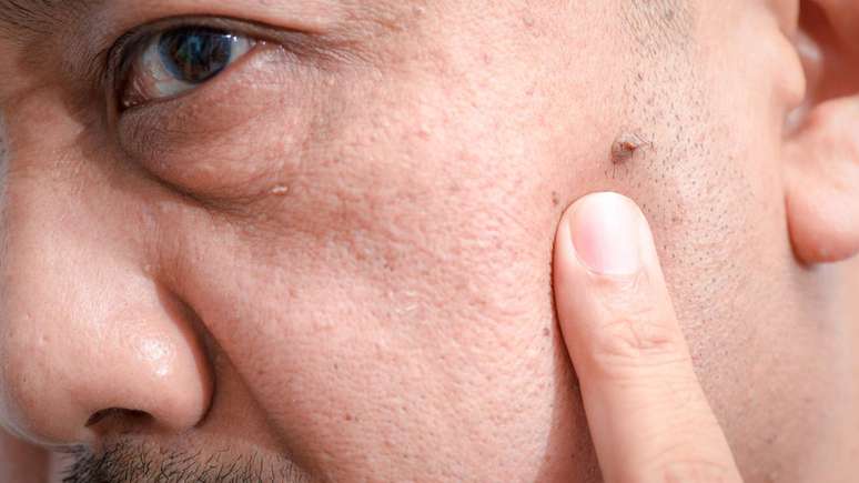 Nem toda verruga pigmentada representa um risco imediato à saúde. A maioria dessas lesões é considerada benigna, ou seja, não representa, em princípio, ameaça grave – depositphotos.com / kwanchaichaiudom