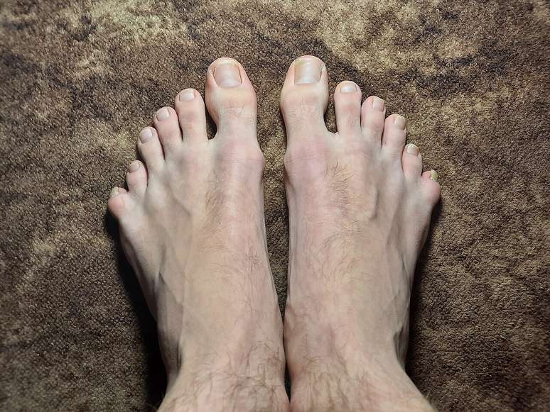 Na polidactilia, o dedo extra pode variar em tamanho, formato e funcionalidade, dependendo de cada pessoa – Zhnka/Wikimedia Commmons