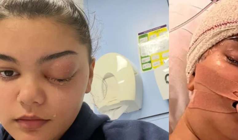 Começou como uma 'gripezinha': olho de adolescente salta 'como uma bola de golfe' e ela descobre infecção bacteriana espalhada no cérebro.