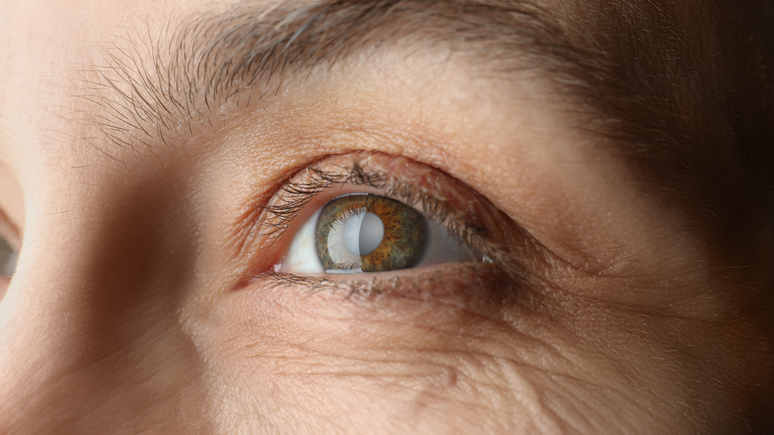 No Brasil, a exposição dos olhos ao sol sem proteção é responsável por provocar 100 mil novos casos de catarata por ano