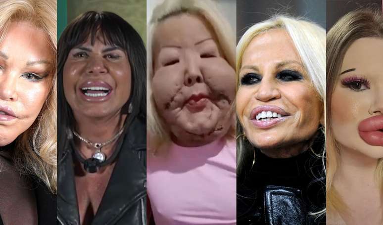 Muito além de Juju do Pix: veja 17 famosas que transformaram seus rostos com cirurgias plásticas e procedimentos estéticos.