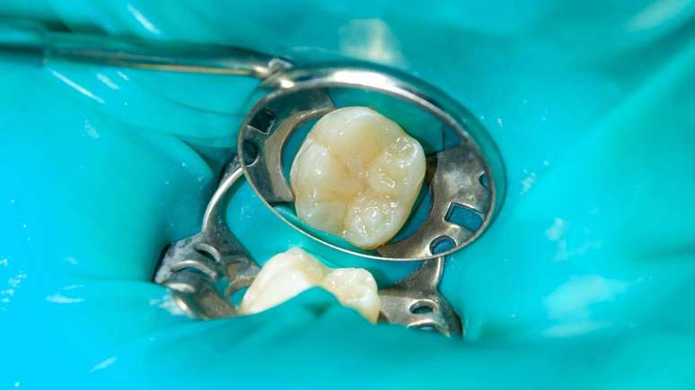 é possível preservar a saúde bucal e garantir que os dentes com amálgama continuem protegidos – depositphotos.com / schigirin91@gmail.com