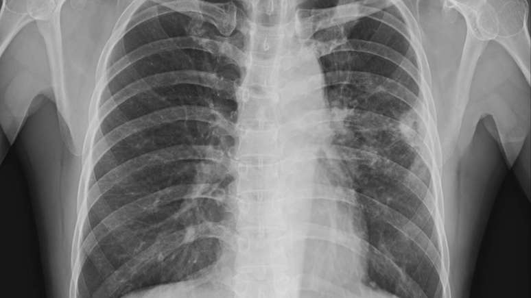 raio-x de pulmão – depositphotos.com / Richmanphoto