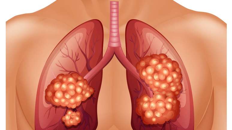 câncer de pulmão – depositphotos.com / blueringmedia